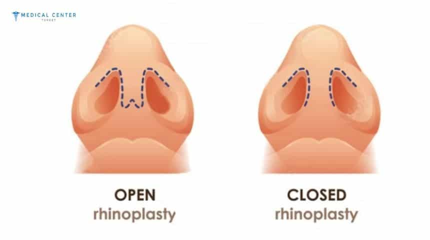 Which Is Better Open or Closed Rhinoplasty?