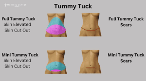 Choosing Between a Tumy Tuck and a Mini Tuck