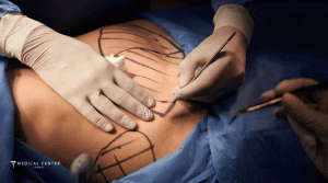 Choosing Between a Tummy Tuck and a Mini Tuck