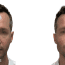 James’s Rhinoplasty Experiences in Turkey