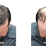 Daniel's Hair Transplant Experience in Turkey