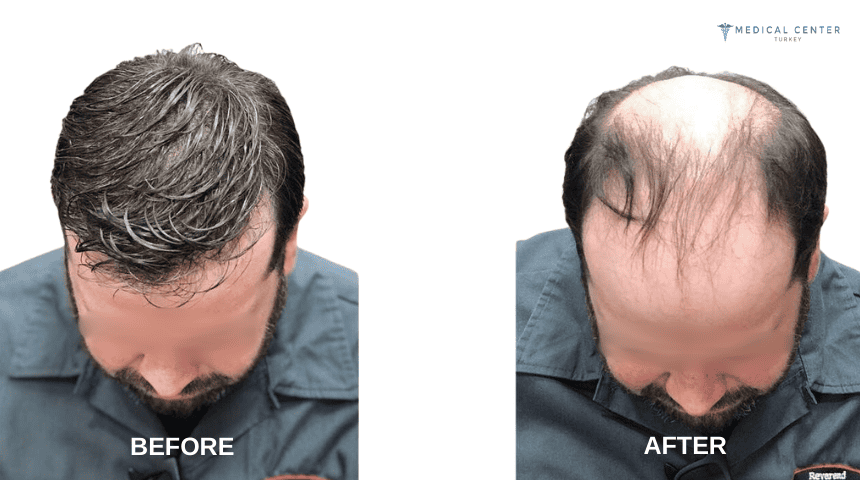 Daniel's Hair Transplant Experience in Turkey