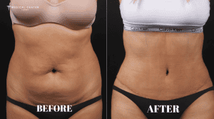 Choosing Between a Tummy Tuck and a Mini Tuck