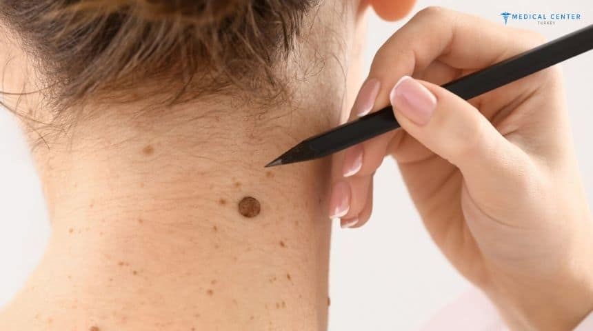 Is Mole Removal Still Popular in 2026? Is Mole Removal Still Popular in 2026?