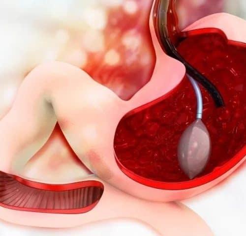 Is the Gastric Balloon Right for You?