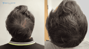 Most Effective Hair Growth Solutions in Turkey