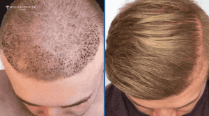 Most Effective Hair Growth Solutions in Turkey