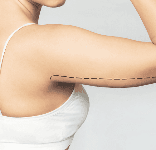 How Arm Lift Surgery Is Evolving in Turkey? How Arm Lift Surgery Is Evolving in Turkey?