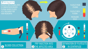 Most Effective Hair Growth Solutions in Turkey