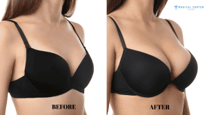 Why Breast Augmentations Deliver Perfect Result in Turkey?