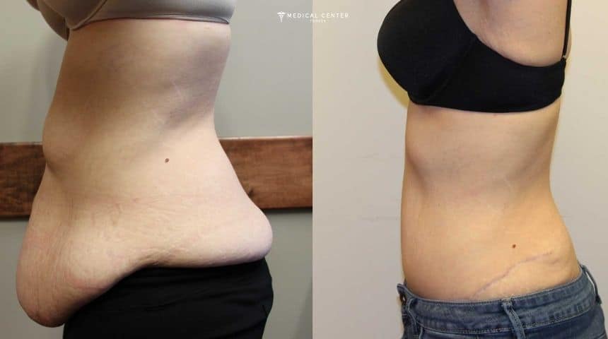 Tummy Tuck Journey Step by Step Experience
