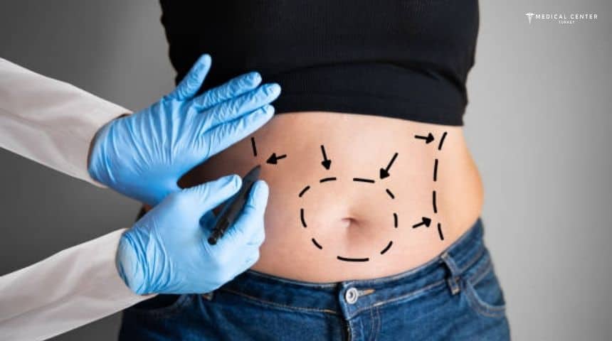 Tummy Tuck Journey Step by Step Experience Tummy Tuck Journey Step by Step Experience