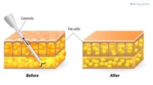 How Liposuction Changes Your Body in Weeks?