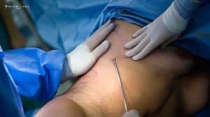 How Liposuction Changes Your Body in Weeks?