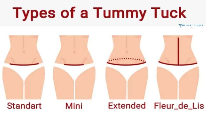 Tummy Tuck Journey Step by Step Experience