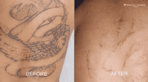 Is Tattoo Removel Permanent?