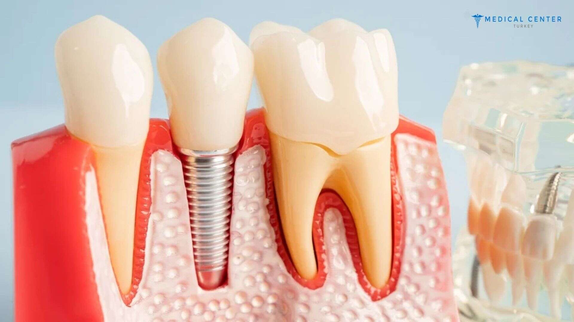 Differences Between Dental Implants and Veneers