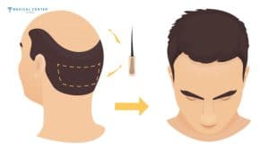 Hair Transplant Recovery Process and Care Tips