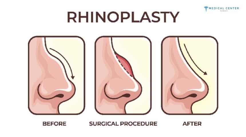 Rhinoplasty Surgery to Improve Facial Balance