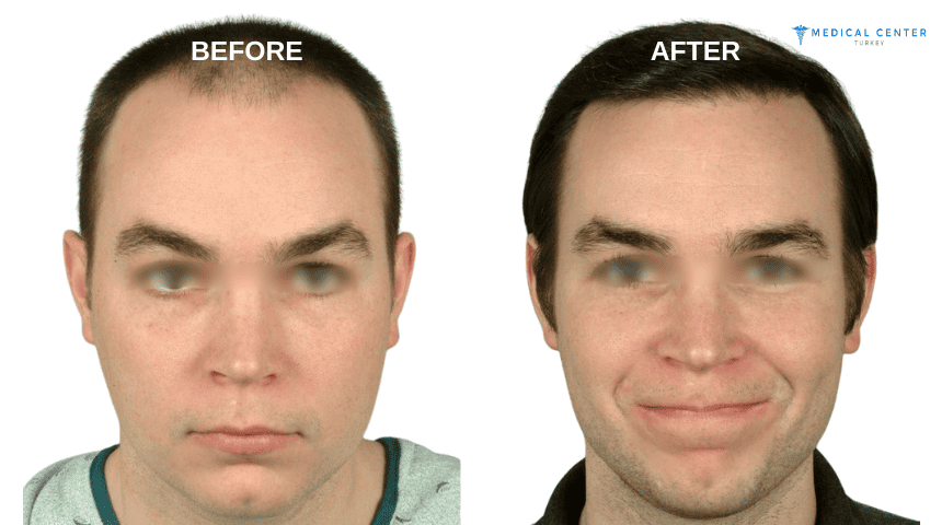 Jun Clapano Hair Transplant Experiences in Turkey Jun Clapano Hair Transplant Experiences in Turkey