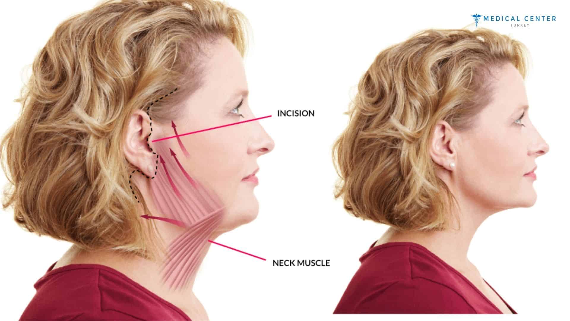Achieving a Rejuvenation with Neck Lift Surgery