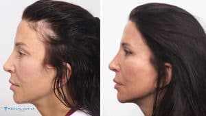 Hair Transplant Recovery Process and Care Tips
