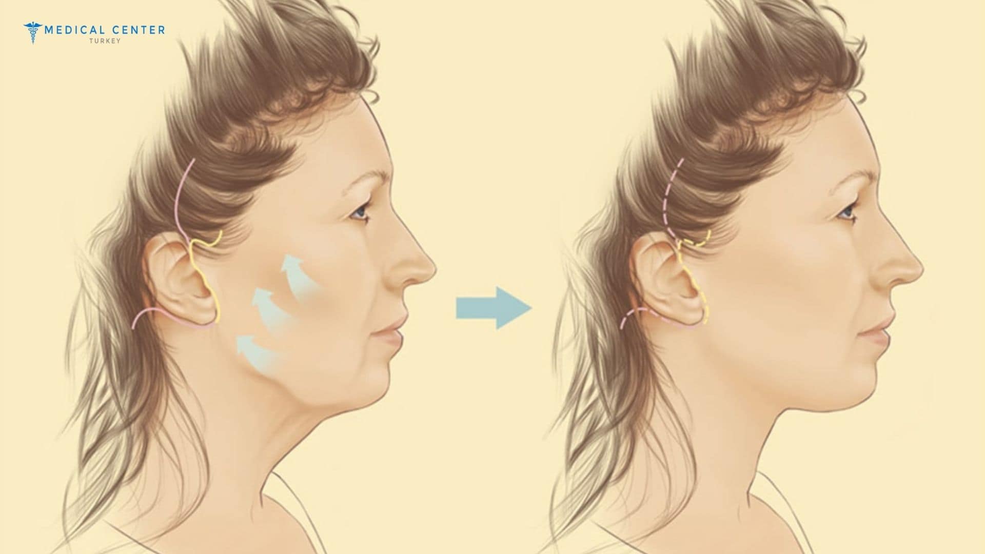 Achieving a Rejuvenation with Neck Lift Surgery