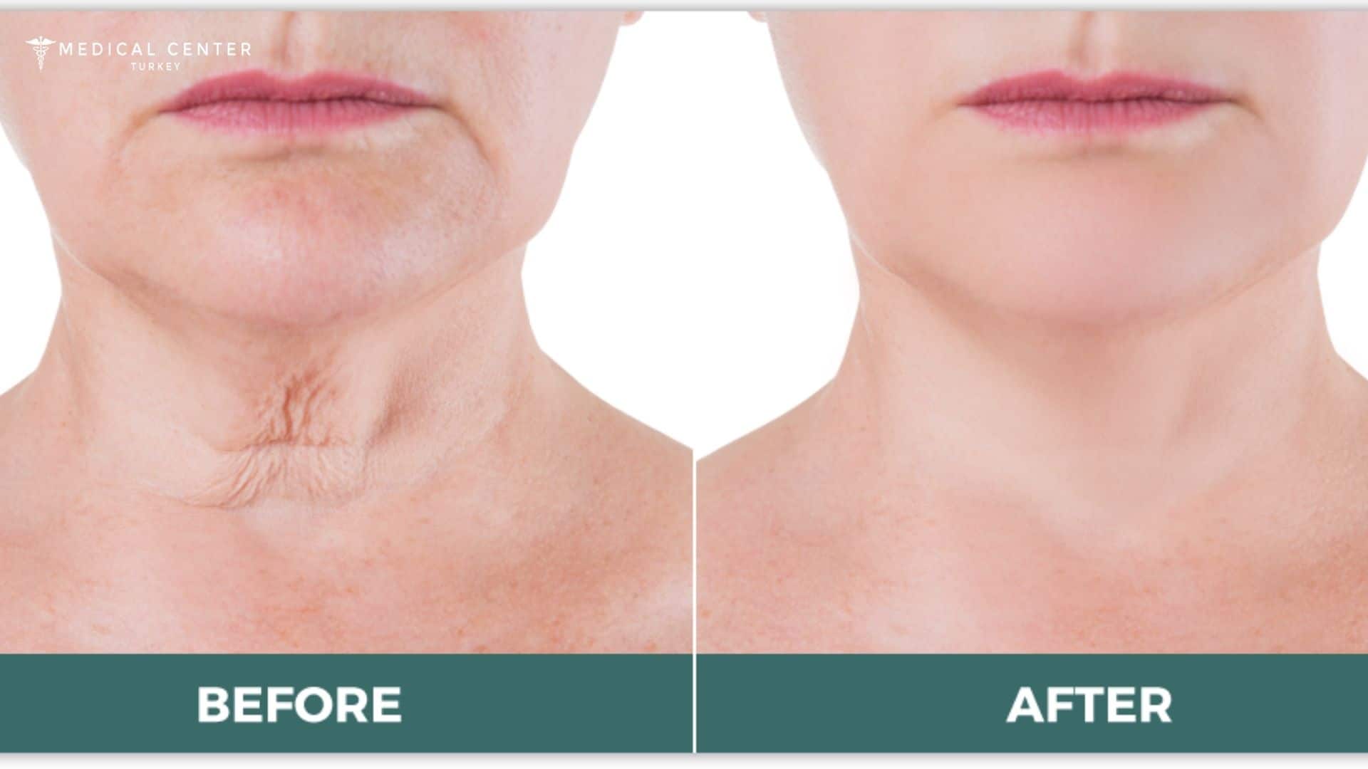 Achieving a Rejuvenation with Neck Lift Surgery