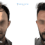 Ahmed’s Hair Transplant Experiences in Turkey