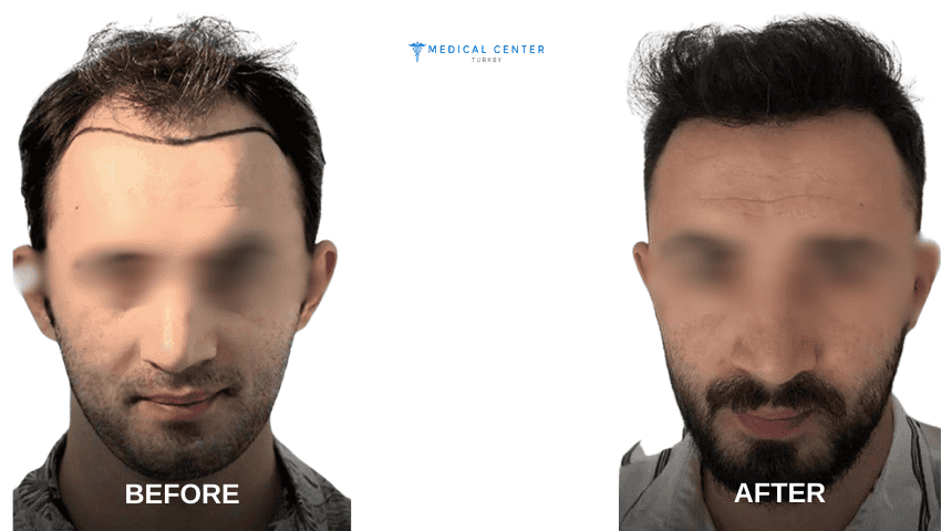 Ahmed’s Hair Transplant Experiences in Turkey