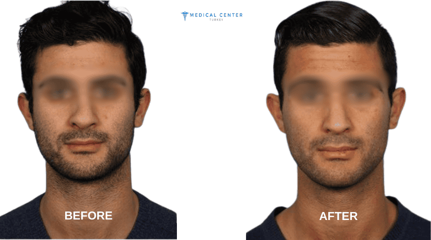 Harris’s Rhinoplasty Experiences in Turkey Harris’s Rhinoplasty Experiences in Turkey