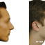 Sean's Rhinoplasty Experiences in Turkey