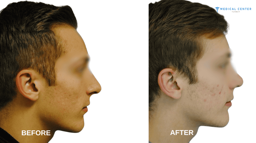 Sean's Rhinoplasty Experiences in Turkey Sean's Rhinoplasty Experiences in Turkey