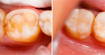 Before and after a tooth-colored composite filling on a back tooth, composite fillings in Leesburg VA
