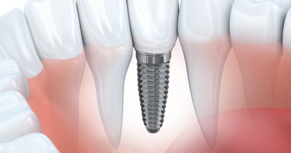 Dental implant post replacing a missing tooth, dental implants in Leesburg VA at Riverside Dental