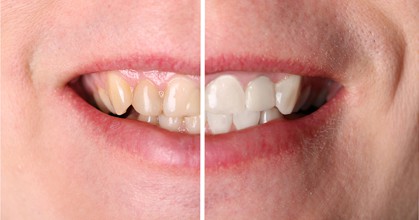 Before and after teeth whitening in Leesburg VA with Riverside Dental's take-home trays