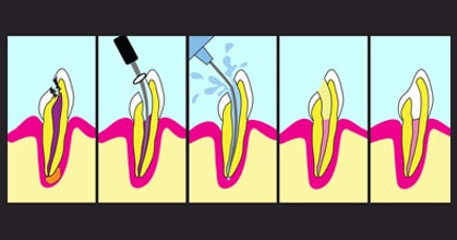 Illustration of the steps of root canal therapy, root canals in Leesburg VA
