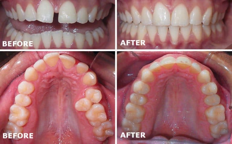 Before and after Invisalign
