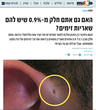 מאקו שאריות זימים בחלק מבני האדם