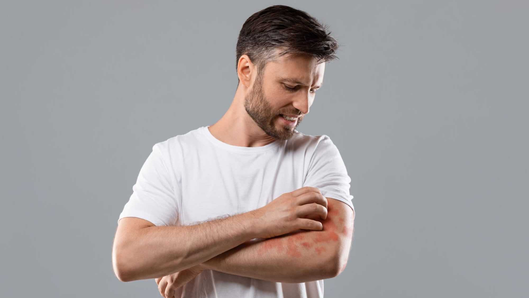 Dermatitis, eczema, allergy, psoriasis concept. Annoyed middle-aged man in white t-shirt scratching itch on his arm, grey studio background. Bearded man itching rash on his elbow, copy space