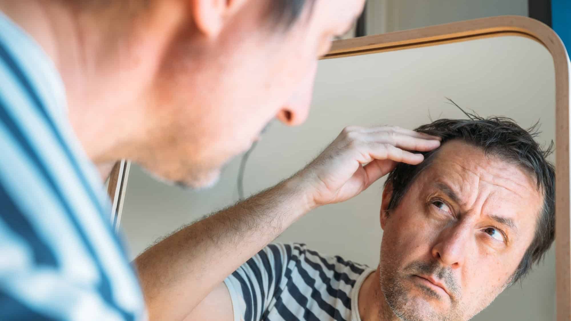 Hair loss concept, worried mature adult male looking at mirror at his forehead hairline