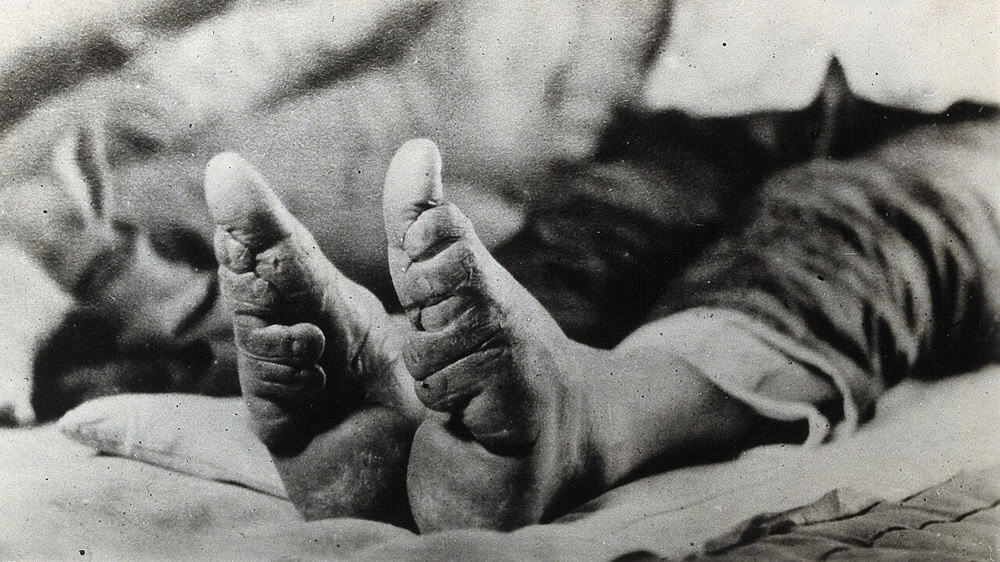 Feet of a Chinese woman, showing the effect of foot-binding