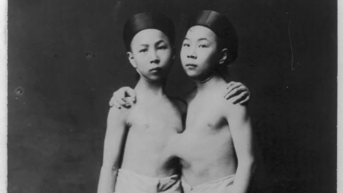 conjoined twins