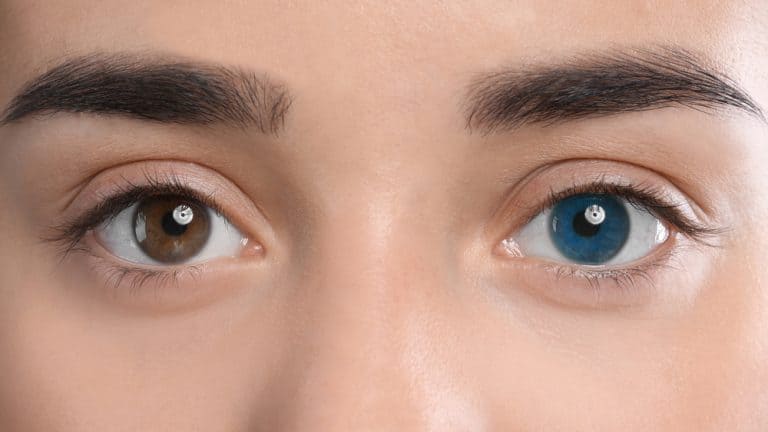 Woman with different colors of eyes, closeup. Heterochromia iridis