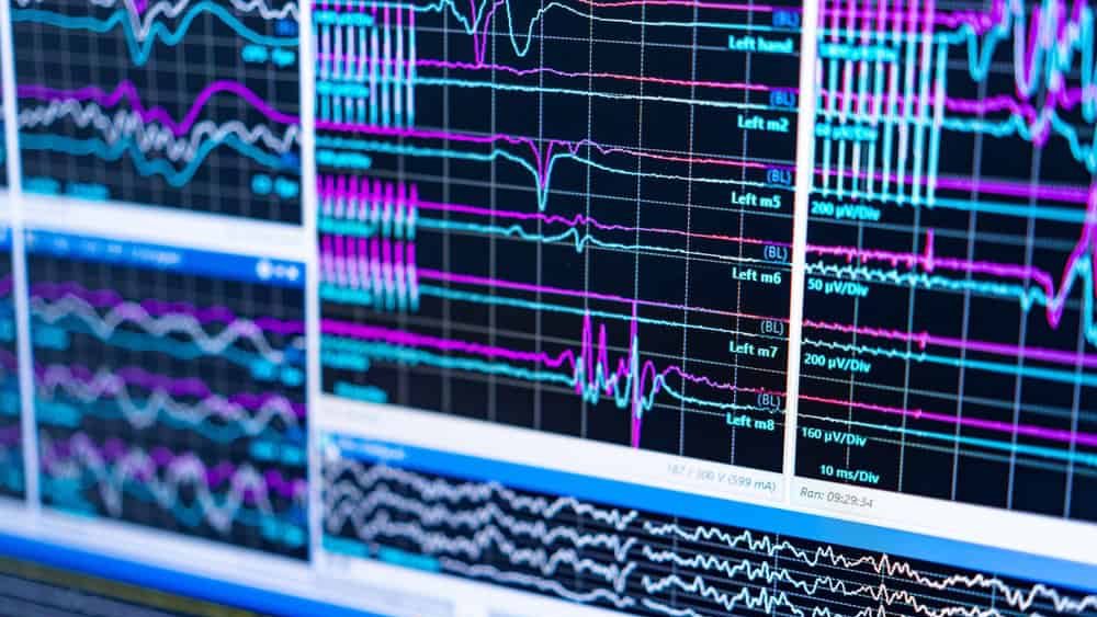 EEG brain wave pattern analysis. Multiple brain wave patterns are displayed on screens, showing electrical activity recorded during an EEG session.