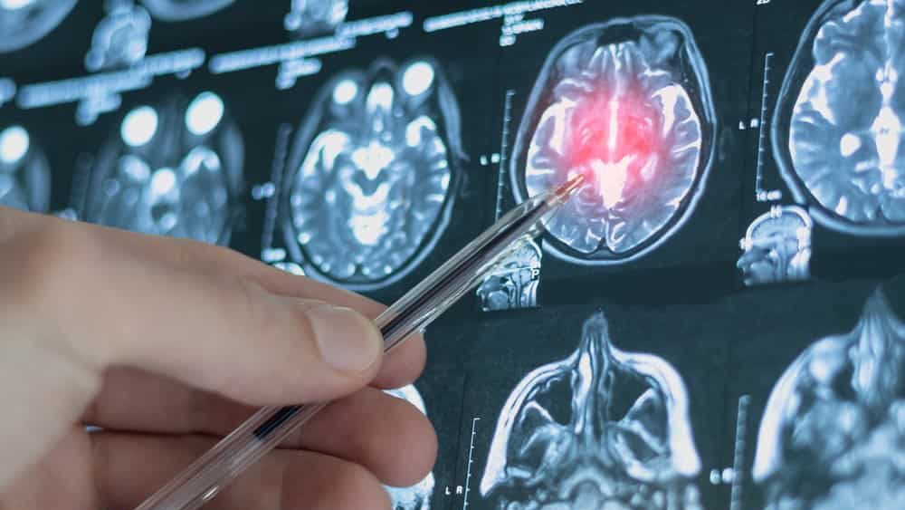 CT scan image of human brain. Mri or x-ray scan for diagnostic human head diseases.