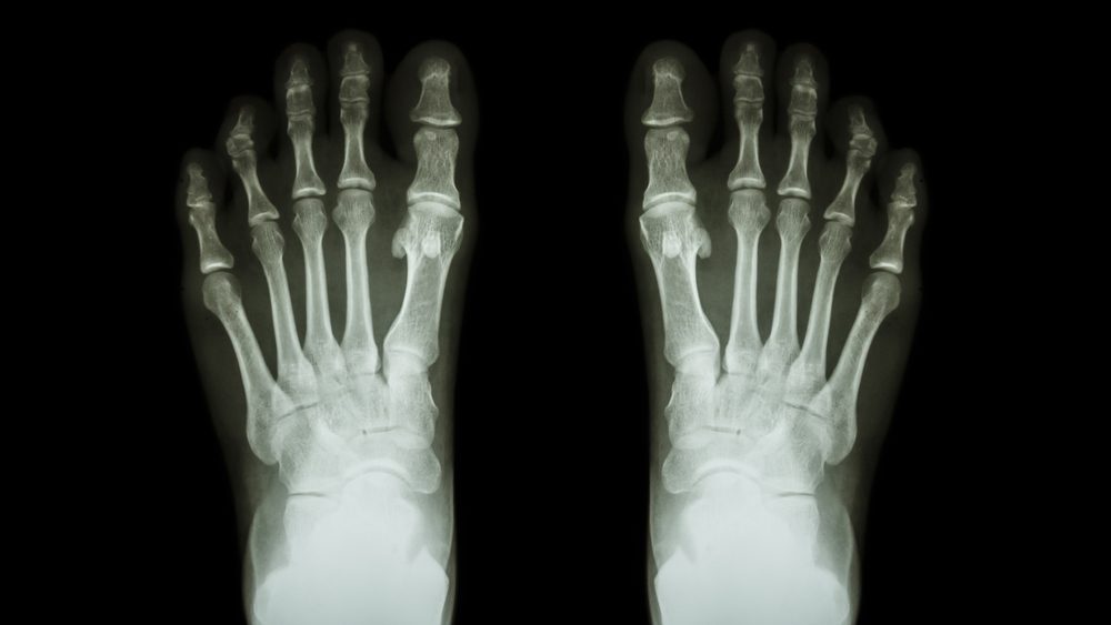 Film x-ray both feet