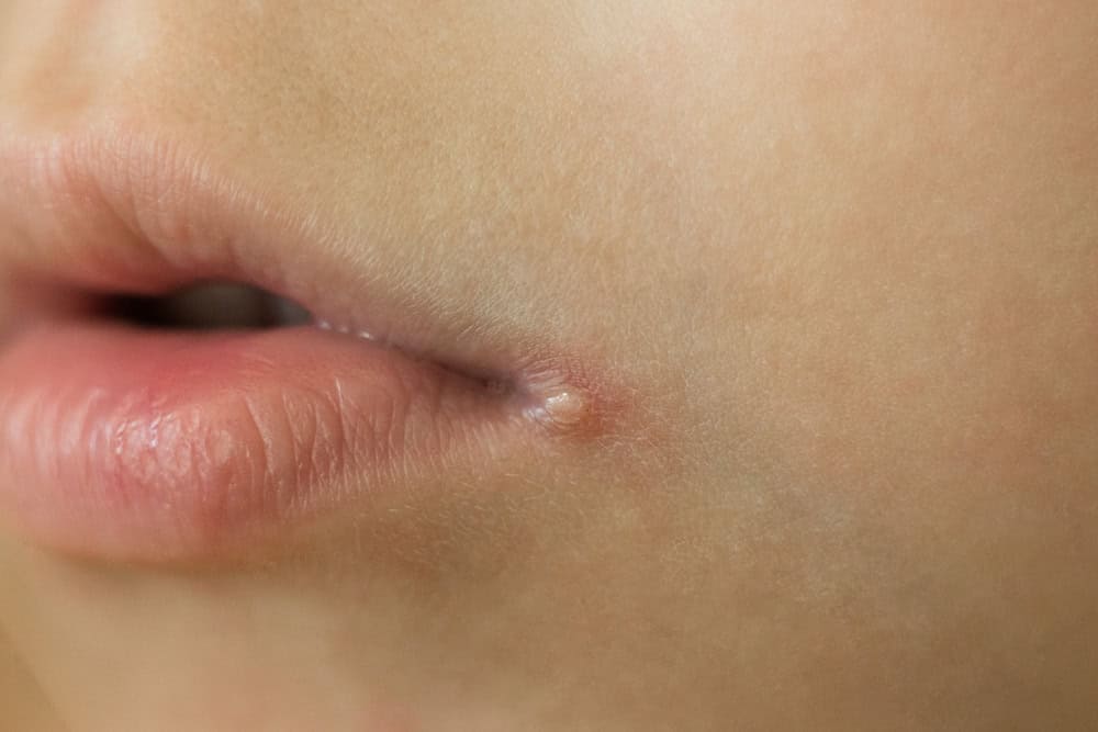 skin problems, angulitis, angular stomatitis, angular cheilitis a disease of the mucous membrane and skin of the corners of the mouth, caused by streptococci.
