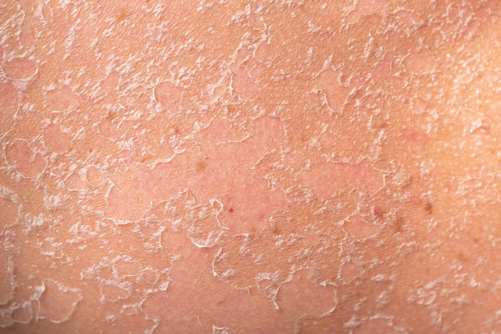 Sunburn, close-up of human skin. Flaky skin from allergies, peeling or eczema. Dry skin in need of treatment and hydration.