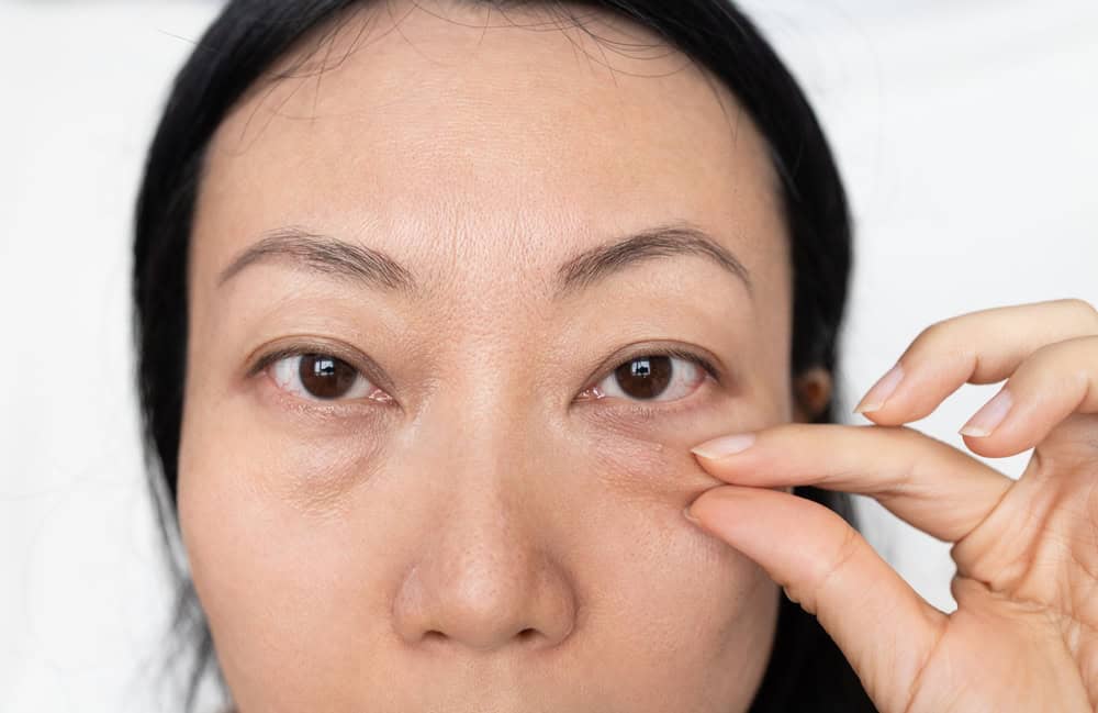 Asian Woman With Under Eye Bag. Puffy Eye Of Girl Showing Eyes Bags.